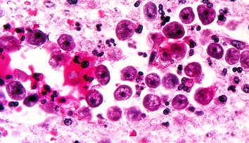 „Mozgožravá“ améba znovu zabíjala: Žena mala mimoriadne nepríjemné príznaky