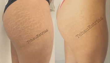 Takto by vám asi nenapadlo zbaviť sa strií. Nová metóda však naozaj funguje