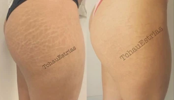 Takto by vám asi nenapadlo zbaviť sa strií. Nová metóda však naozaj funguje