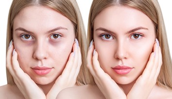 Trápia vás kruhy pod očami? Takto s nimi zatočíte