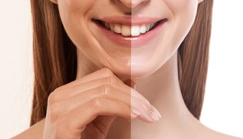 Trendy, ktoré sľubujú žiarivý úsmev. Skutočne fungujú?