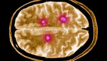 Vedci poukázali na nenápadný príznak sklerózy multiplex. Objavuje sa 15 rokov pred prepuknutím choroby