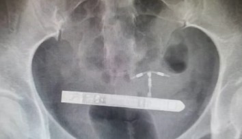 Pár si chcel spestriť romantické chvíle. Skončilo sa to bolestivými vibráciami v bruchu a operáciou