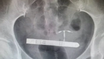 Pár si chcel spestriť romantické chvíle. Skončilo sa to bolestivými vibráciami v bruchu a operáciou