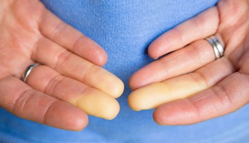 Menia vám ruky v zime farbu? Radšej to neignorujte