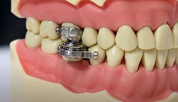 Novodobé chudnutie alebo spôsob mučenia? Vedci predstavili magnetický prístroj na chudnutie