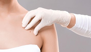 Zanedbávate kontroly u kožného lekára? Rakovina sa môže objaviť aj na miestach, na ktoré zabúdame