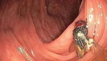 Nečakaný objav počas kolonoskopie: Do kamery zavedenej do čreva sa pozerala živá mucha