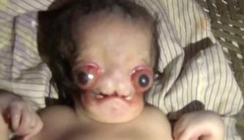 V Indii sa narodilo bábätko, ktoré vyzerá ako mimozemšťan. Matka sa ho nevzdá