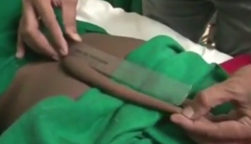 Indický tínedžer žil s 18-centimetrovým chvostom, teraz ho museli odrezať