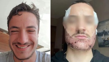 Študent si vzal život po tom, čo mu v Turecku transplantoval bradu realitný maklér vydávajúci sa za chirurga