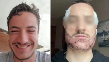 Študent si vzal život po tom, čo mu v Turecku transplantoval bradu realitný maklér vydávajúci sa za chirurga