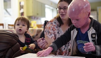 Chlapček trpí unikátnou chorobou. Abnormálne rýchlo mu rastie koža