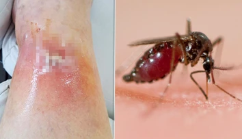 Obyčajný štípanec sa zmenil na nočnú moru. Slovenka mala o pár dní na nohe otvorenú ranu