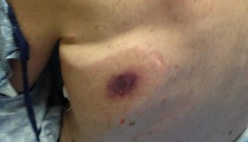 Muž (†66) zomrel po nakazení baktériou, tú istú dostal na dovolenke v Bulharsku aj Čech