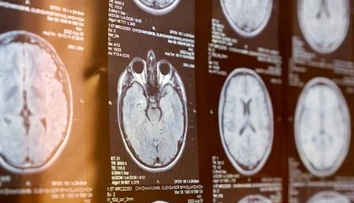 Pri mozgovej príhode rozhodujú minúty. Neurochirurg opísal príznaky, ktoré netreba ignorovať