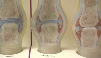 Reuma postihuje aj mladých ľudí. Ak máte tieto príznaky, treba spozornieť