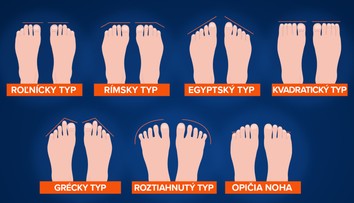 Viete, aký máte typ chodidla? Podľa tvaru zistíte, aké zdravotné problémy vám hrozia