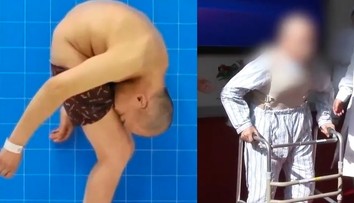 Lekári ukončili trápenie muža, ktorý prežil väčšinu života v krkolomnej polohe