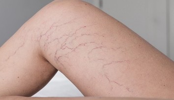 Myslíte si, že sú to len žilky? Metličky na nohách môžu byť varovným signálom