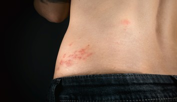 Nebezpečný pásový opar. Pre toto si naň dajte pozor a predchádzajte mu