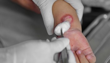 Doma mali vážne popáleného syna (6), ignorovali to. Teraz ich súd poslal do väzenia