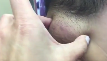 Na krku mal hrču veľkú ako golfová loptička. To, čo z nej vyliezlo, je len pre silné žalúdky