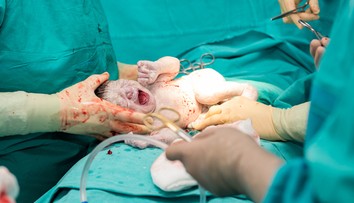 Je cisársky rez nebezpečný trend? Odborník to povedal natvrdo