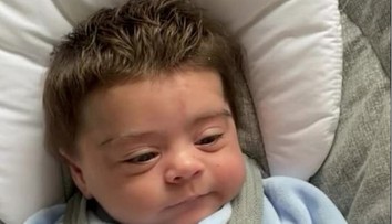 Chlapček sa narodil s bujnou hrivou. Lekári zistili, že trpí vzácnym syndrómom