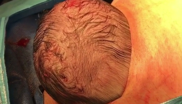 Fascinujúce zábery cisárskeho rezu. Dieťa sa samé predralo na svet