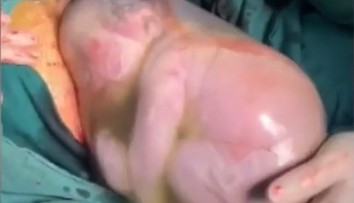 Chlapček sa narodil s "čepcom šťasteny". Dýchať začal až po dvoch minútach