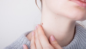 Zdanlivo neškodné znamienko? Všímajte si tieto zmeny podľa metódy ABCDE