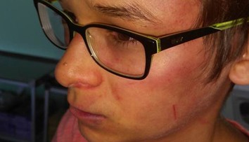 Ďalší dobitý chlapec. Matka tvrdí, že na jej syna zaútočil riaditeľ školy