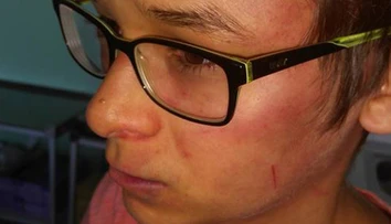 Ďalší dobitý chlapec. Matka tvrdí, že na jej syna zaútočil riaditeľ školy