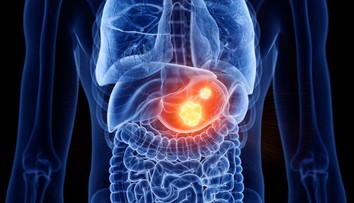 Nenápadná baktéria môže spustiť vážne ochorenie. Odborníci radia, čo robiť, aby ľudia predišli rakovine žalúdka