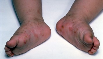 Na Slovensku pribúdajú prípady svrabu, najviac ohrozené sú deti a tínedžeri