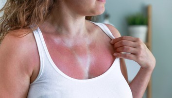 Letné slnko je čoraz silnejšie. Pokožka sa na ňom nemusí iba spáliť, ale môže sa zmeniť aj vaša DNA