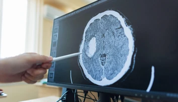 Revolúcia v liečbe rakoviny: Nový test skrátil diagnostiku nádorov mozgu z týždňov na hodiny