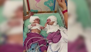 Zriedkavá operácia sa podarila: Siamské dvojičky sa videli prvýkrát tvárou v tvár