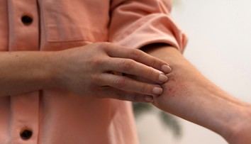 Kožná forma celiakie. Durhingova choroba sa prejavuje vyrážkami podobnými herpesu