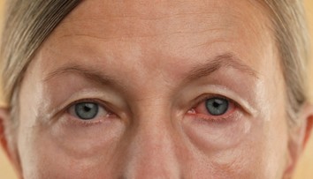 Oči môžu varovať pred chorobami. Upozornia na anémiu aj mozgovú príhodu