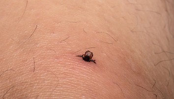 Zostal vám po vybratí kúsok kliešťa v koži? Lekárka radí, čo s ním určite nerobiť