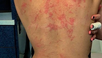 Nahá liezla po skalách a spadla. Speváčka zverejnila nelichotivé zábery