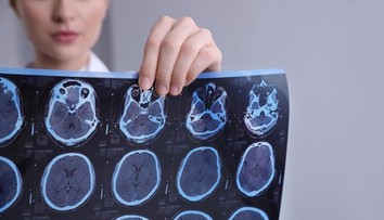 Vedci odhalili bunky, ktoré ničia mozog. Objav môže zmeniť liečbu sklerózy