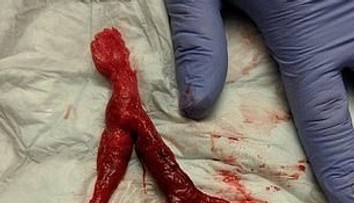 Muž sa sťažoval na bolesť chrbta a nevoľnosť: V pľúcach mu našli obrovskú zrazeninu