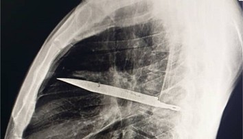 Prípad, ktorý šokoval lekárov. Muž žil osem rokov s nožom v hrudi