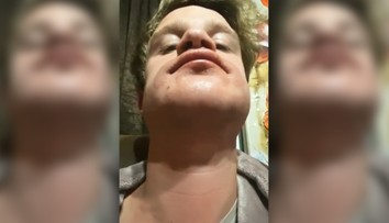 Žena chcela priateľovi natrieť bradu farbou na vlasy. Bizarný nápad skončil popáleninami