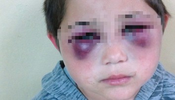 Podliatiny okolo očí a modriny na tele. Dobitého Ivanka (8) našli v zúboženom stave