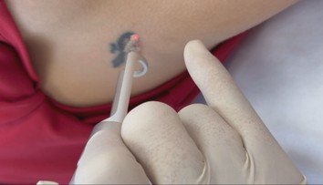 Namiesto tetovaní je trendom čistá pokožka. Boli sme sa pozrieť, ako vyzerá odstránenie laserom