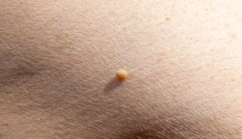 Malé kožné výrastky vyzerajú nevinne. Dermatologička varuje pred ich domácim odstraňovaním